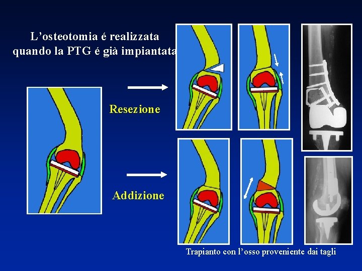 L’osteotomia é realizzata quando la PTG é già impiantata Resezione Addizione Trapianto con l’osso