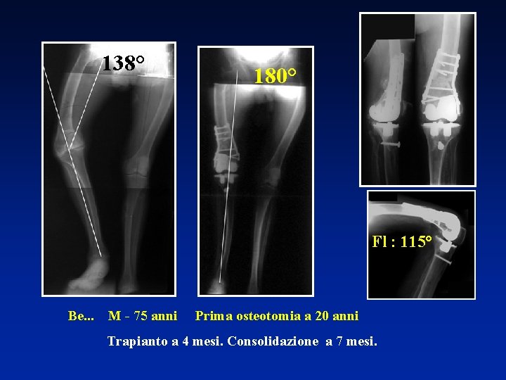 138° 180° Fl : 115° Be. . . M - 75 anni Prima osteotomia