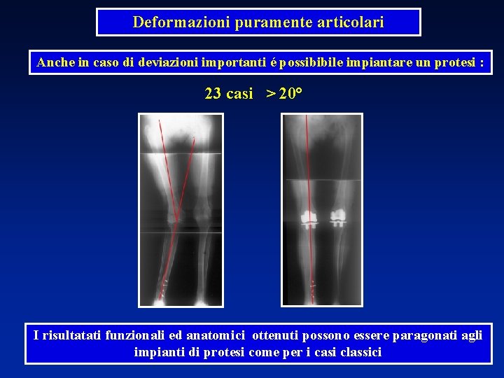 Deformazioni puramente articolari Anche in caso di deviazioni importanti é possibibile impiantare un protesi