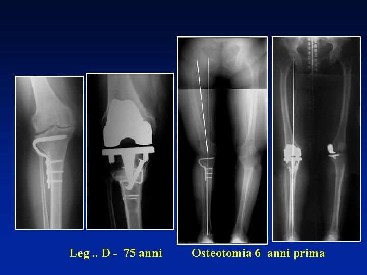 Leg. . D - 75 anni Osteotomia 6 anni prima 