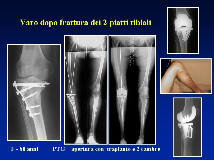 Varo dopo frattura dei 2 piatti tibiali F - 80 anni PTG + apertura