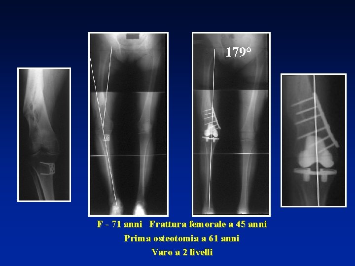 179° F - 71 anni Frattura femorale a 45 anni Prima osteotomia a 61