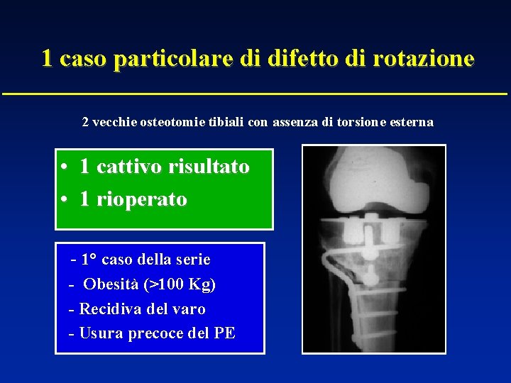 1 caso particolare di difetto di rotazione 2 vecchie osteotomie tibiali con assenza di