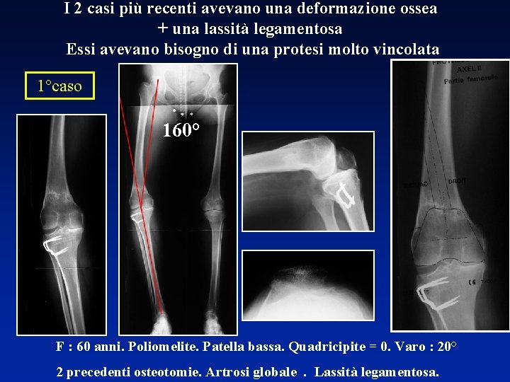 I 2 casi più recenti avevano una deformazione ossea + una lassità legamentosa Essi