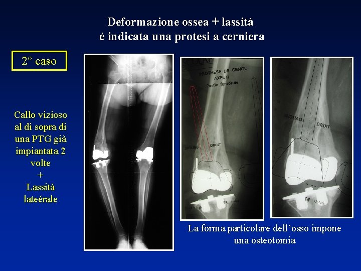 Deformazione ossea + lassità é indicata una protesi a cerniera 2° caso Callo vizioso