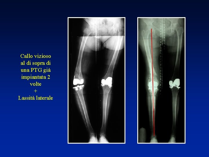 Callo vizioso al di sopra di una PTG già impiantata 2 volte + Lassità