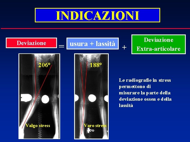 INDICAZIONI Deviazione 206° = usura + lassità + Deviazione Extra-articolare 188° Le radiografie in