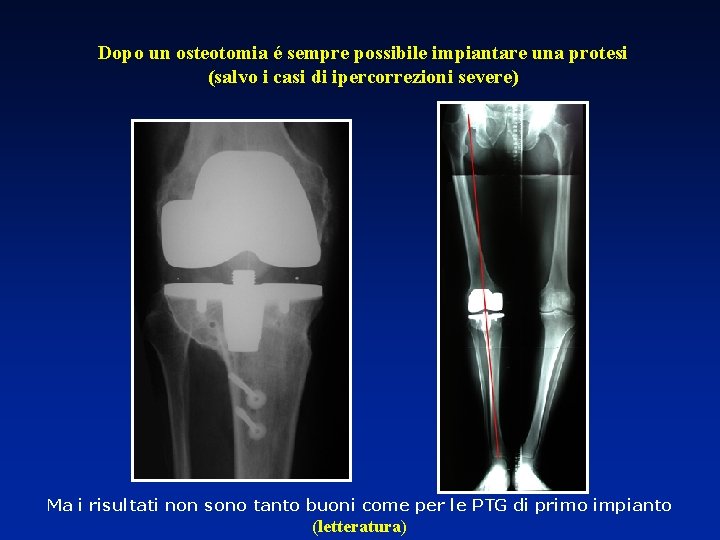Dopo un osteotomia é sempre possibile impiantare una protesi (salvo i casi di ipercorrezioni
