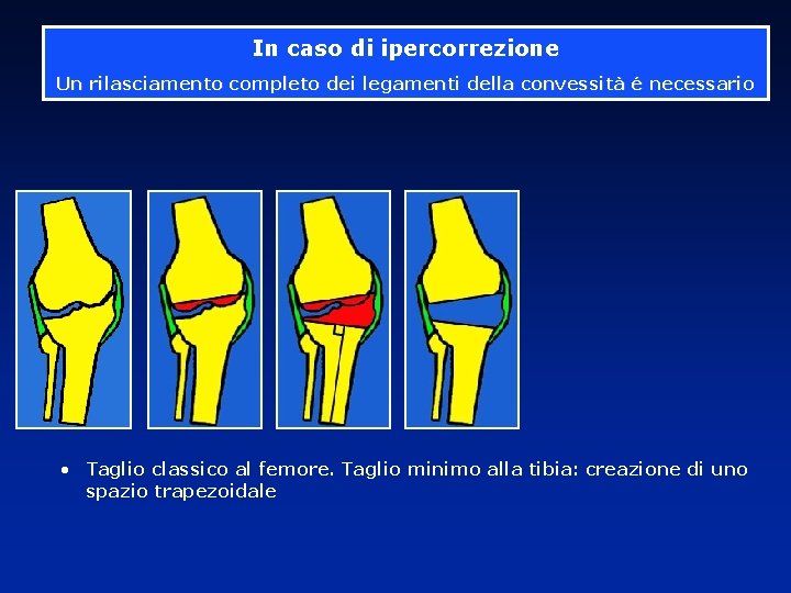 In caso di ipercorrezione Un rilasciamento completo dei legamenti della convessità é necessario •