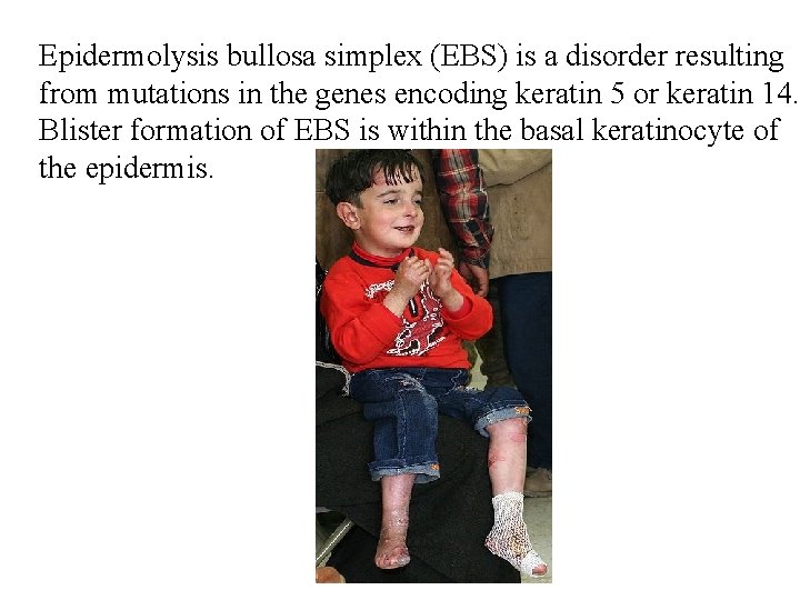 Epidermolysis bullosa simplex (EBS) is a disorder resulting from mutations in the genes encoding Epidermolysis bullosa simplex (EBS) is a disorder resulting from mutations in the genes encoding