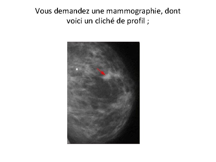 Vous demandez une mammographie, dont voici un cliché de profil ; 