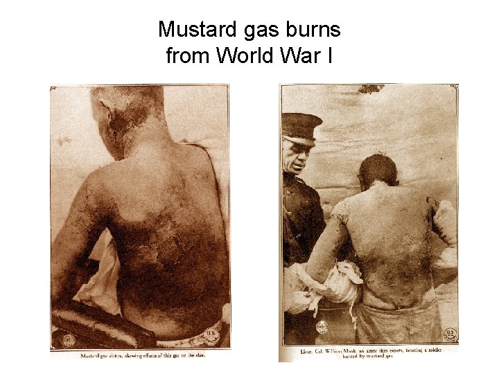 Mustard gas burns from World War I 