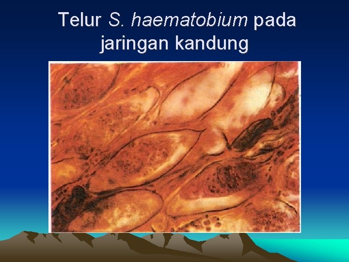 Telur S. haematobium pada jaringan kandung 