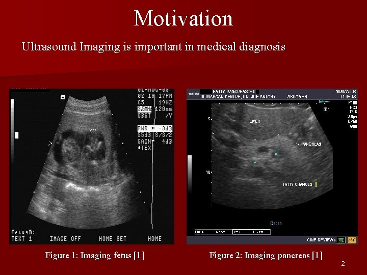 Motivation Ultrasound Imaging is important in medical diagnosis Figure 1: Imaging fetus [1] Figure