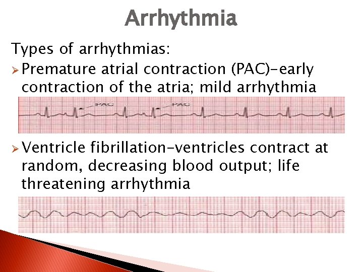 Arrhythmia Types of arrhythmias: Ø Premature atrial contraction (PAC)-early contraction of the atria; mild