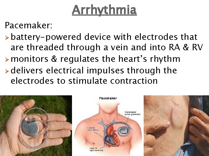 Arrhythmia Pacemaker: Ø battery-powered device with electrodes that are threaded through a vein and
