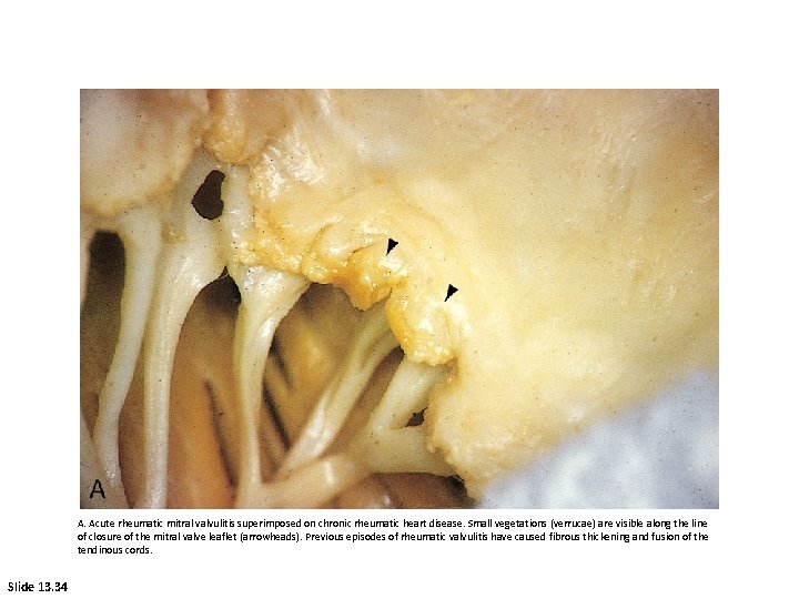 A. Acute rheumatic mitral valvulitis superimposed on chronic rheumatic heart disease. Small vegetations (verrucae)