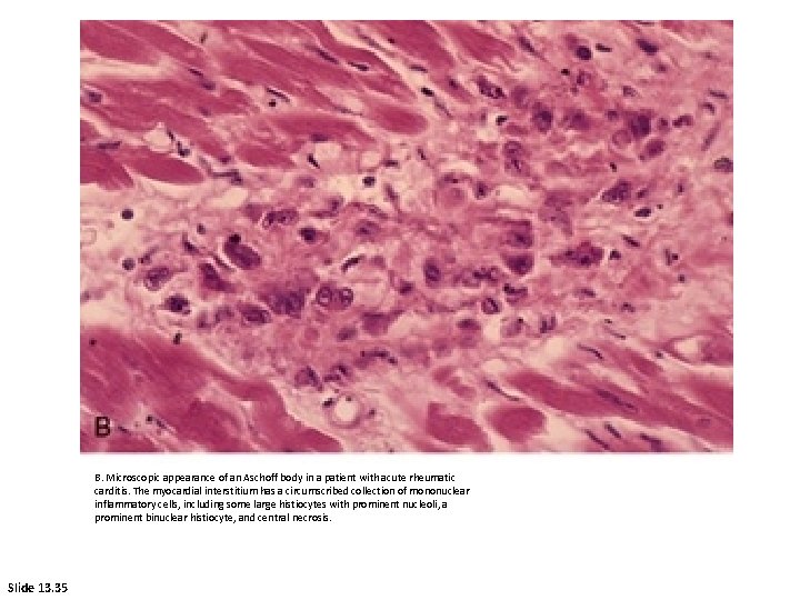 B. Microscopic appearance of an Aschoff body in a patient with acute rheumatic carditis.