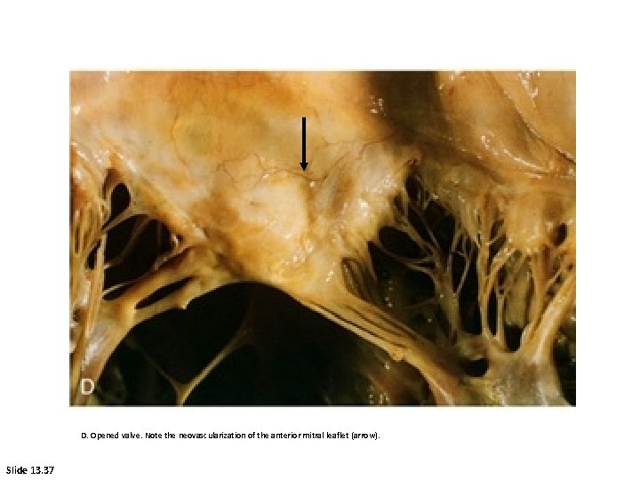 D. Opened valve. Note the neovascularization of the anterior mitral leaflet (arrow). Slide 13.