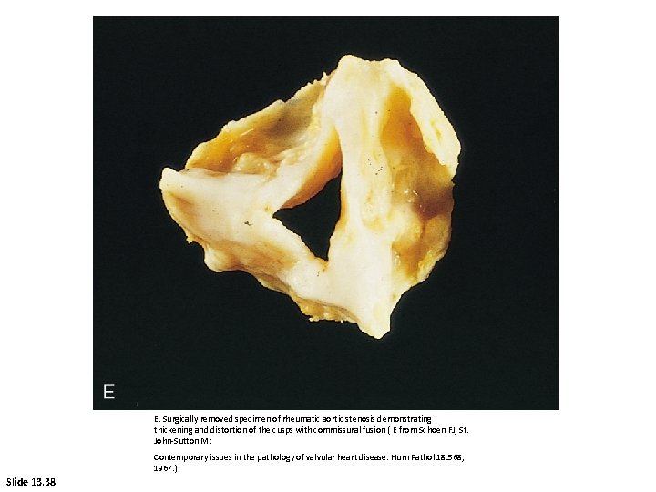 E. Surgically removed specimen of rheumatic aortic stenosis demonstrating thickening and distortion of the