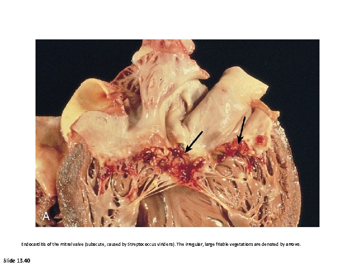 Endocarditis of the mitral valve (subacute, caused by Streptococcus viridens). The irregular, large friable