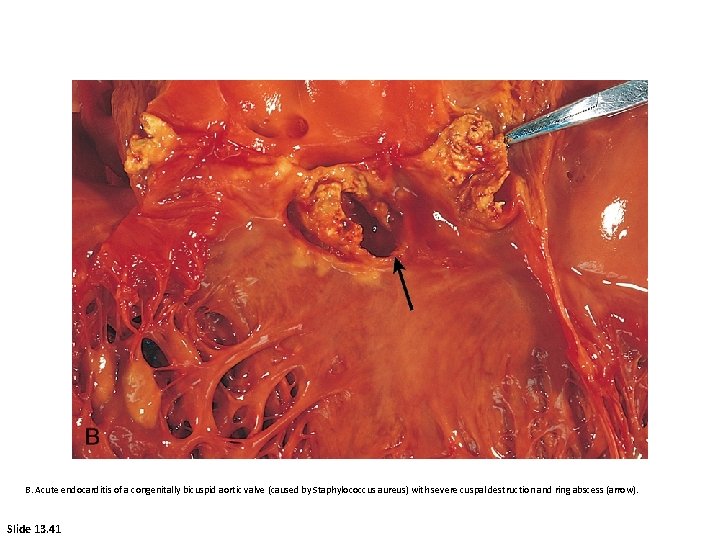 B. Acute endocarditis of a congenitally bicuspid aortic valve (caused by Staphylococcus aureus) with