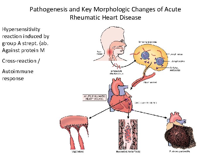 Pathogenesis and Key Morphologic Changes of Acute Rheumatic Heart Disease Hypersensitivity reaction induced by