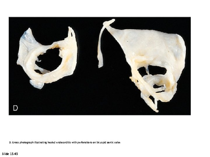 D. Gross photograph illustrating healed endocarditis with perforations on bicuspid aortic valve Slide 13.