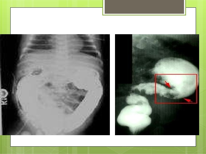 Barium enema 