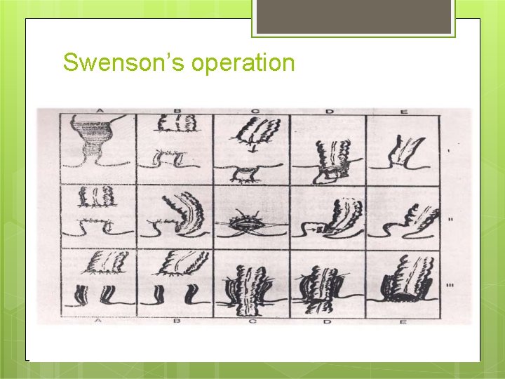 Swenson’s operation 