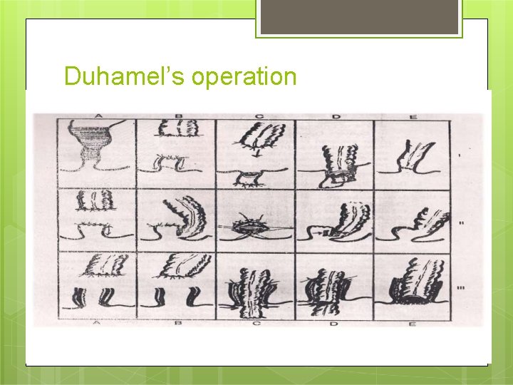 Duhamel’s operation 