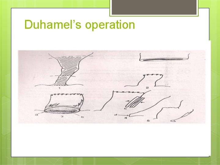 Duhamel’s operation 