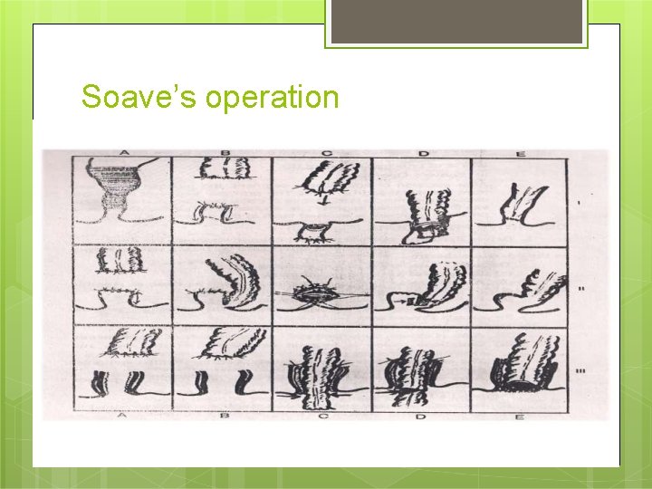 Soave’s operation 