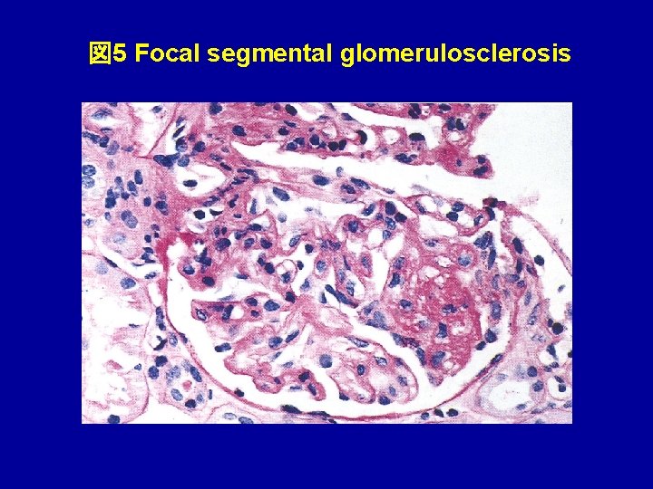 図 5 Focal segmental glomerulosclerosis 