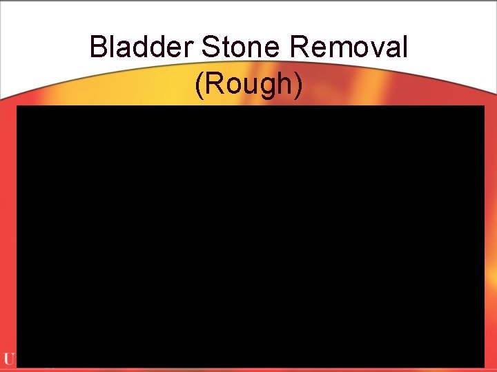 Bladder Stone Removal (Rough) 