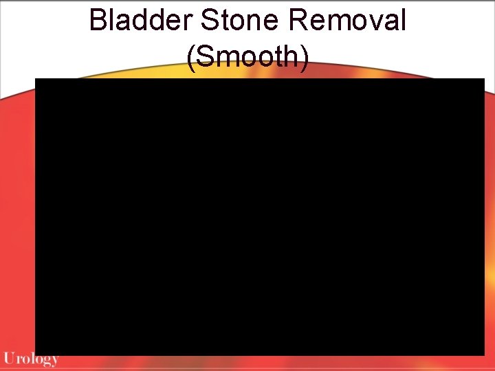 Bladder Stone Removal (Smooth) 