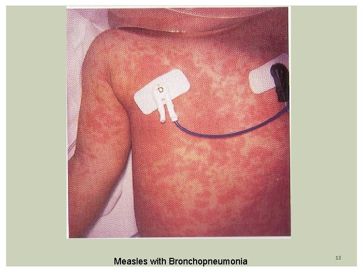 Measles with Bronchopneumonia 12 