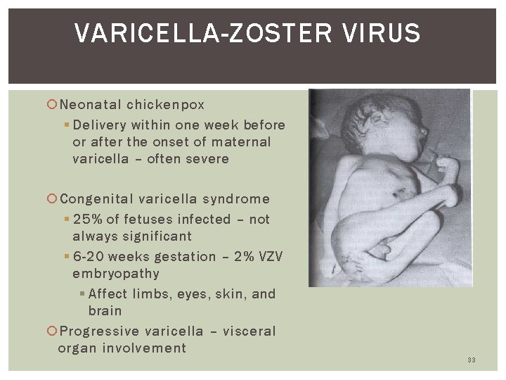 VARICELLA-ZOSTER VIRUS Neonatal chickenpox § Delivery within one week before or after the onset