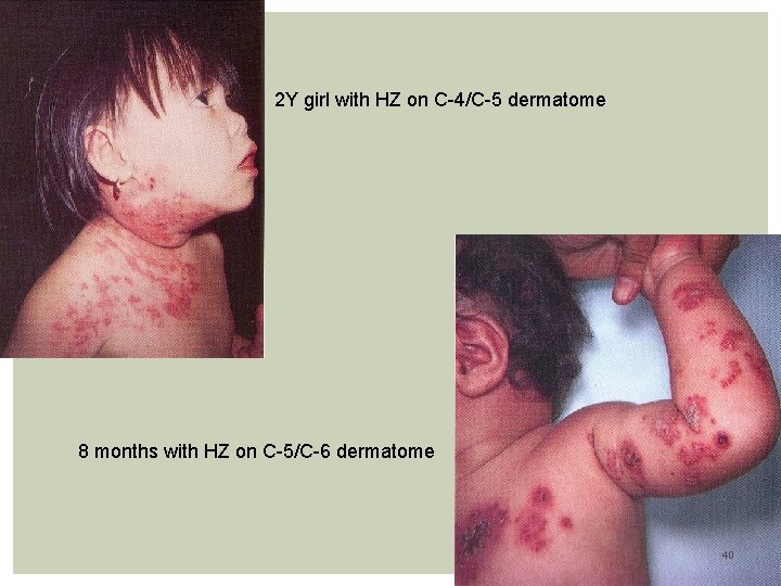 2 Y girl with HZ on C-4/C-5 dermatome 8 months with HZ on C-5/C-6