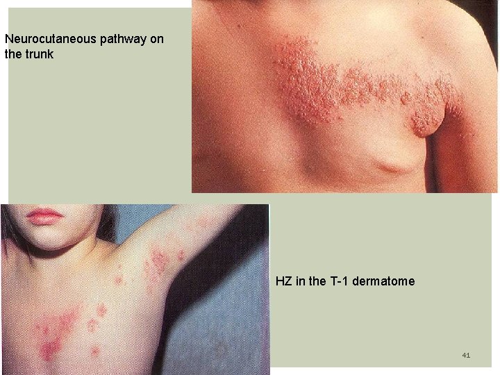 Neurocutaneous pathway on the trunk HZ in the T-1 dermatome 41 