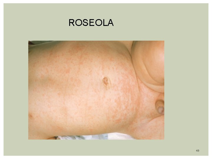 ROSEOLA 49 