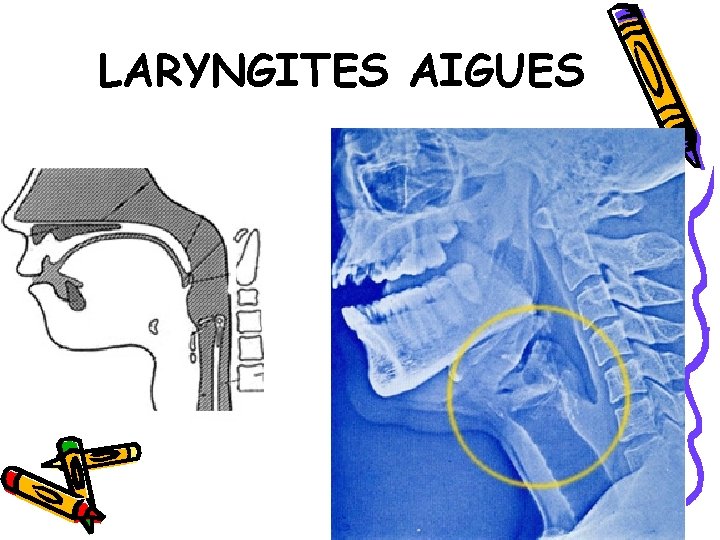 LARYNGITES AIGUES 