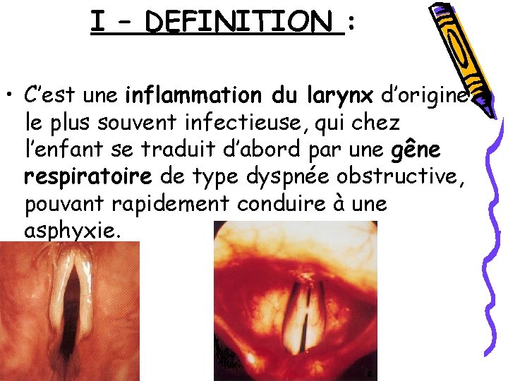I – DEFINITION : • C’est une inflammation du larynx d’origine le plus souvent