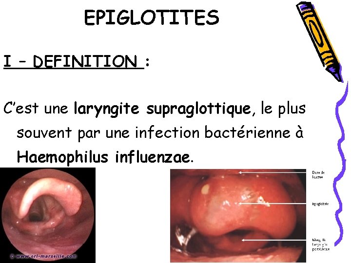 EPIGLOTITES I – DEFINITION : C’est une laryngite supraglottique, le plus souvent par une