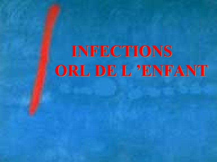 INFECTIONS ORL DE L ’ENFANT 