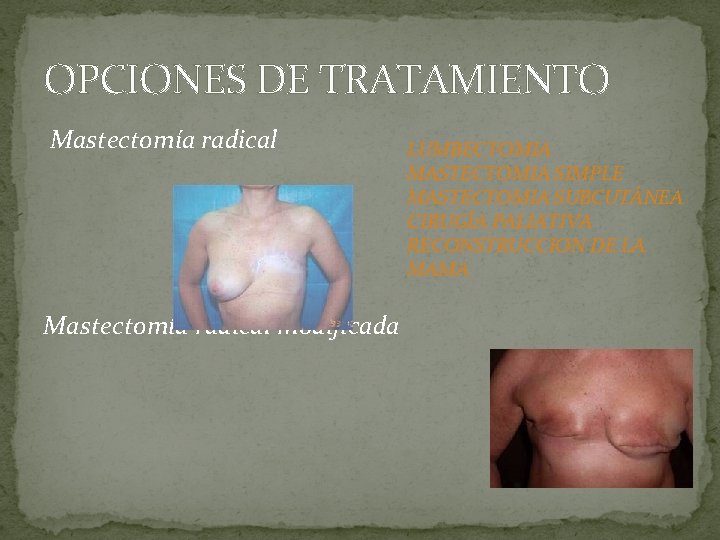 OPCIONES DE TRATAMIENTO Mastectomía radical modificada LUMBECTOMIA MASTECTOMIA SIMPLE MASTECTOMIA SUBCUTÁNEA CIRUGÍA PALIATIVA RECONSTRUCCION