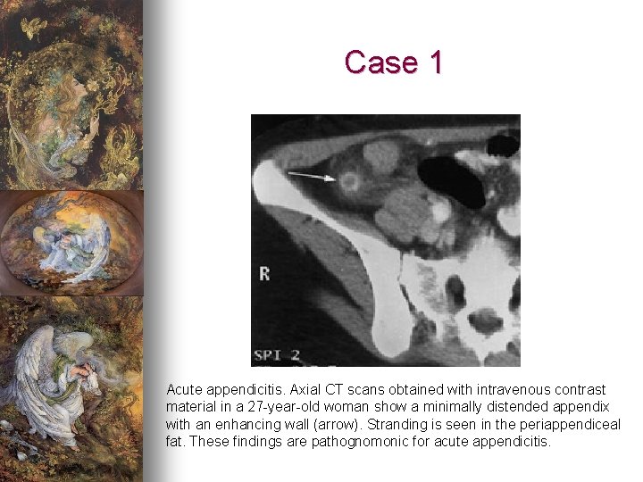 Case 1 Acute appendicitis. Axial CT scans obtained with intravenous contrast material in a