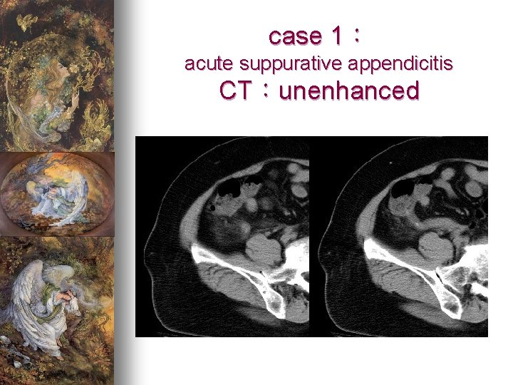 case 1： acute suppurative appendicitis CT：unenhanced 