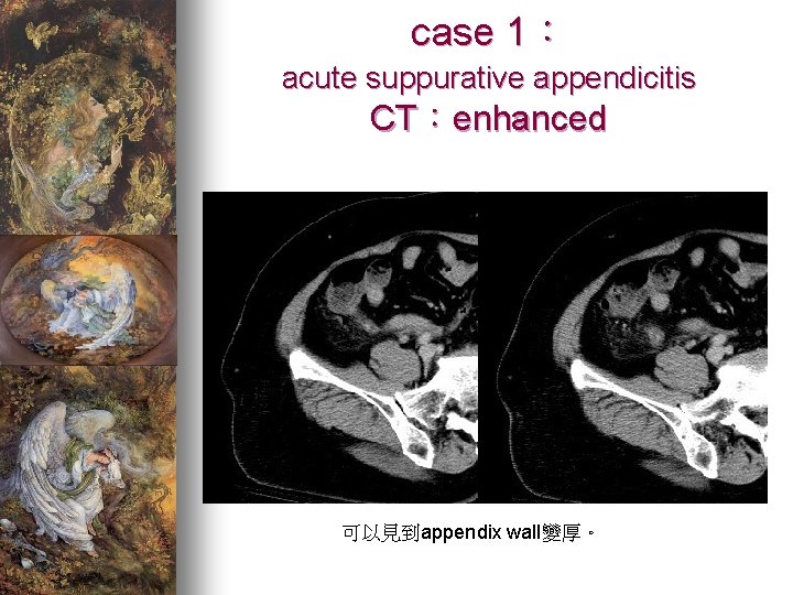 case 1： acute suppurative appendicitis CT：enhanced 可以見到appendix wall變厚。 