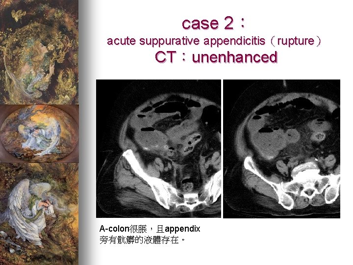 case 2： acute suppurative appendicitis（rupture） CT：unenhanced A-colon很脹，且appendix 旁有骯髒的液體存在。 